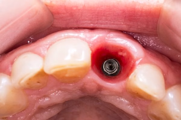 colocación de implantes