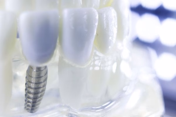 Implantes dentales PREMIUM